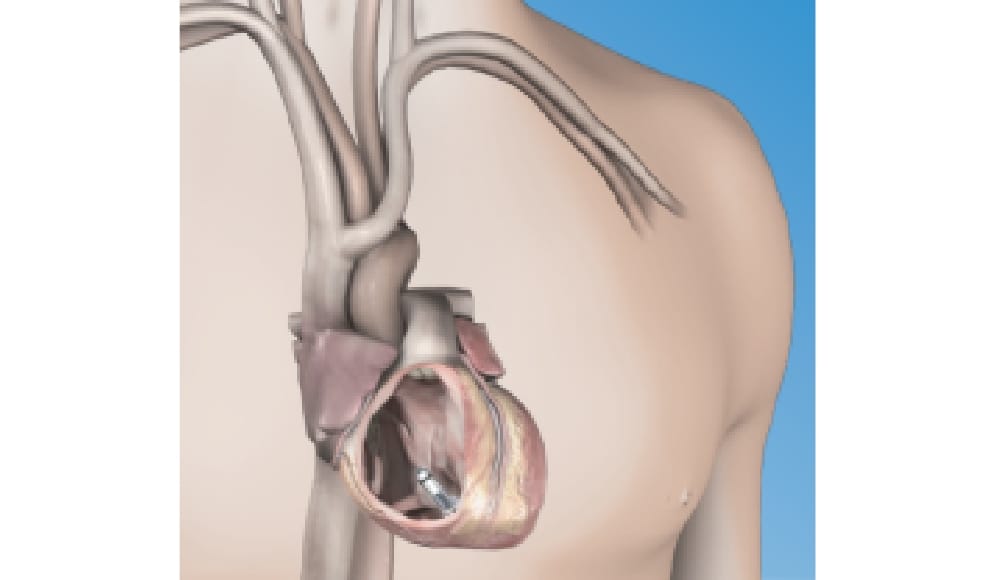 リードレスペースメーカ手術01