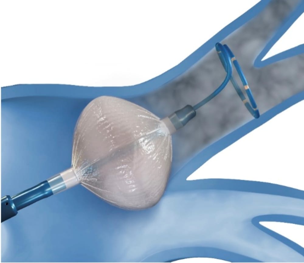 冷凍凝固バルーンによるアブレーションイメージ