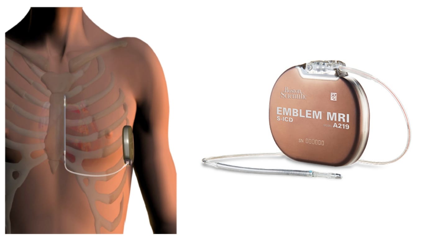 皮下植え込み型除細動器(S-ICD)