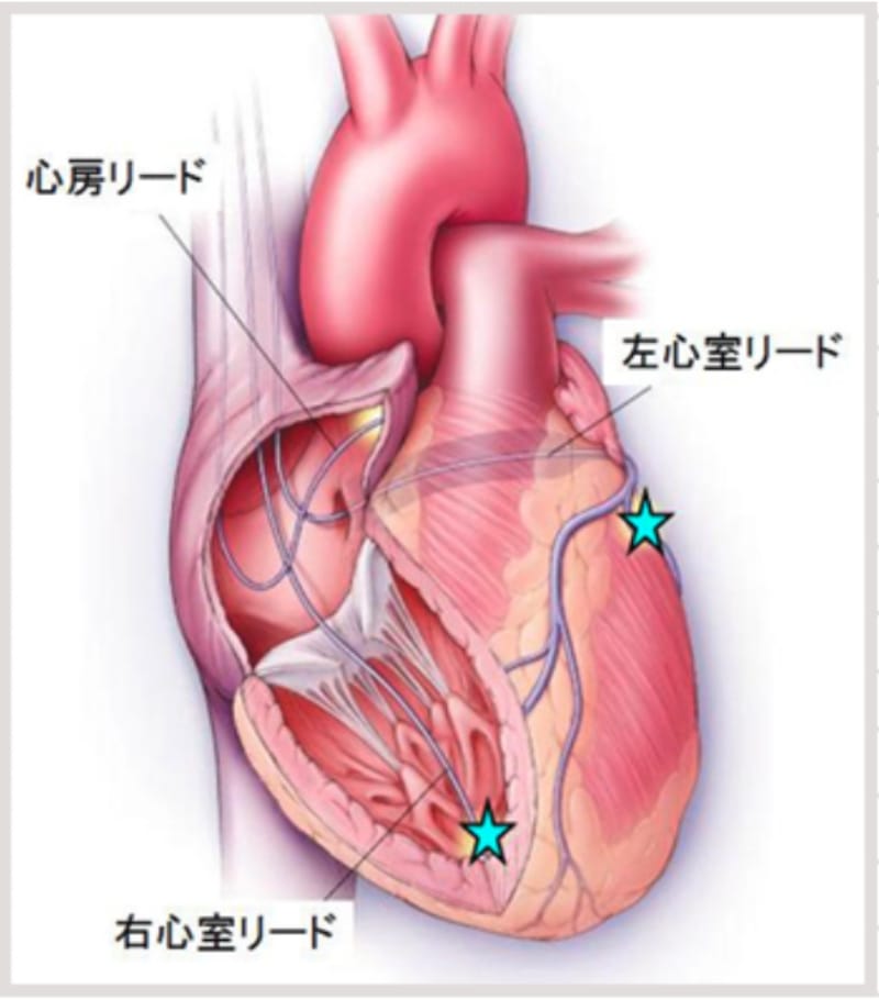 心臓再同期療法（CRT）