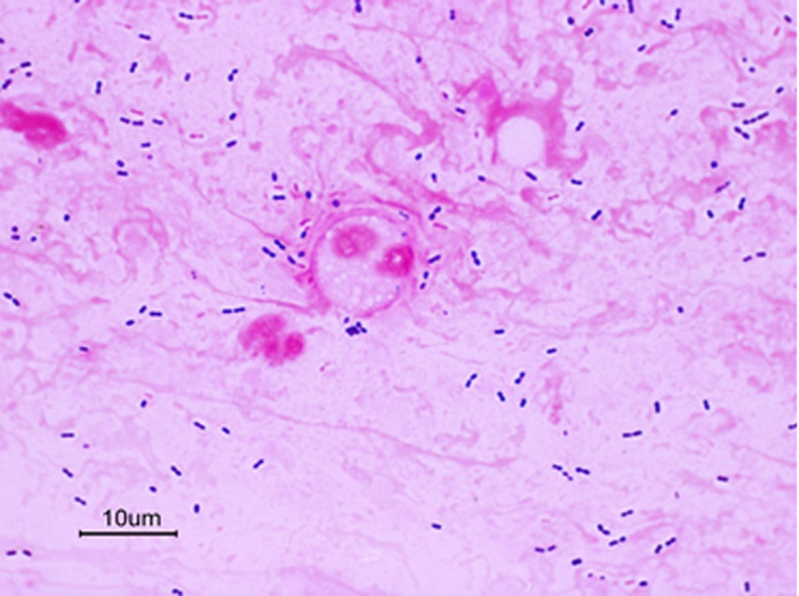 中央が白血球、小さな青いものが細菌です