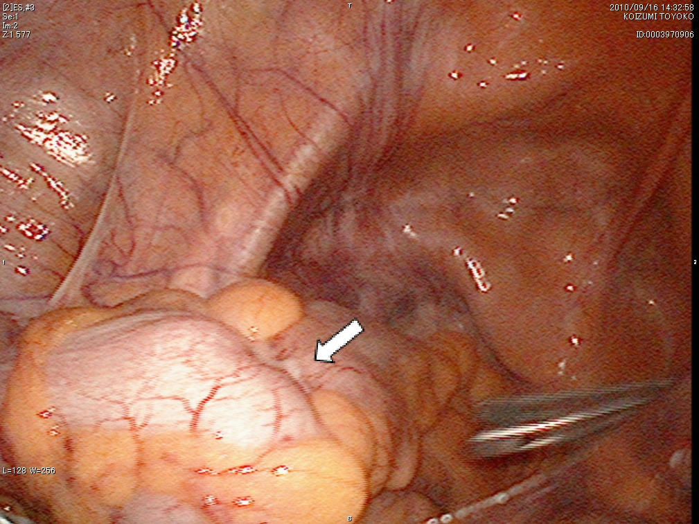 a）病変部位（⇩）