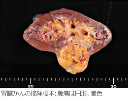 腎臓がんの摘除標本
