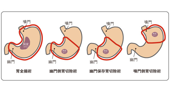 胃切除の方法図