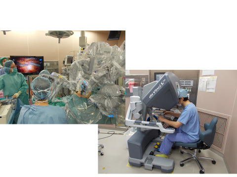 幽門側胃切除術写真